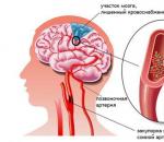 Léčba mozkové aterosklerózy - léky