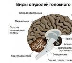 Nádor mozku u dětí - příznaky v raných stádiích, příčiny, léčba