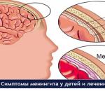 הסימנים והתסמינים הראשונים של דלקת קרום המוח בילדים: כיצד לזהות מחלה מסוכנת, שיטות טיפול ומניעה