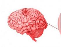 Тархины судасны эмгэгийн эрсдэл юу вэ?
