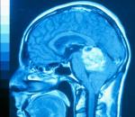 Rak mozga: prvi simptomi, liječenje i prognoza za cijeli život