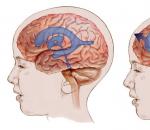 Hydrocefalus (voda v mozgu)