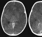 Příčiny a následky mozkového edému hlavy