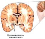 Beyin kanseri: belirtileri ve tedavisi