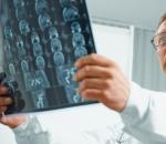 Tumore al cervello: sintomi, segni, trattamento