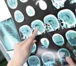 Novità nel trattamento della sclerosi multipla in Russia