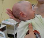 Simptomat e hidrocefalusit të trurit tek të porsalindurit dhe fëmijët nën një vjeç, pasojat dhe trajtimi i rënies