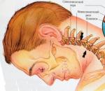 Schwindel bei zervikaler Osteochondrose: Symptome