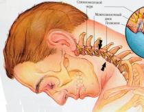 סחרחורת עם אוסטאוכונדרוזיס צוואר הרחם: תסמינים