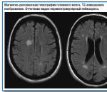 Koje bolesti uzrokuju lezije u mozgu na MRI?