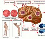 Рак на мозъка: симптоми в ранните стадии и прогноза за излекуване