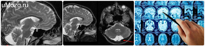 Шишковидной железы ребенка. Ретроцеребеллярная киста мрт. Арахноидальная киста эпифиза. Киста шишковидной железы головного мозга мрт. Ретроцеребеллярная киста в головном мозге мрт.