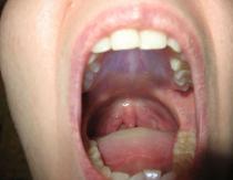 Es schmerzt den Gaumen im Mund: Was sind die Ursachen und die Behandlung?