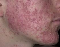 Unidox Solutab para el acné Unidox Solutab ayuda contra el acné