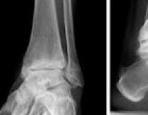 Artrosi dell'articolazione della caviglia (caviglia): sintomi e trattamento, cause, descrizione della malattia