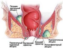 Características da dieta para doença de Crohn, alimentos permitidos e proibidos, cardápio, regras gerais e nutrição durante uma exacerbação Dieta no pós-operatório da doença de Crohn