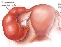 Segni di infiammazione delle appendici nelle donne e trattamento della patologia