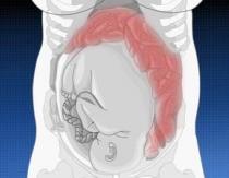 ท้องผูกระหว่างตั้งครรภ์ - จะทำอย่างไร?
