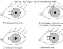 Occhio di pterigio dopo precauzioni chirurgiche